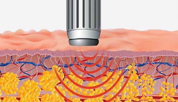 Коррекция фигуры 1 00 global Udarno volnovaya terapiya