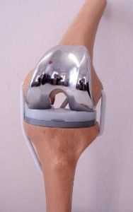 ehndoprotezirovanie sustavov 6